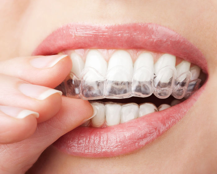 Straighten Your Teeth Seamlessly With Invisalign Treatment In Strongsville, OH